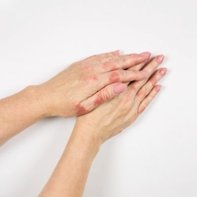 Female hands are affected by dermatitis. Eczema on the hands. Close-up.